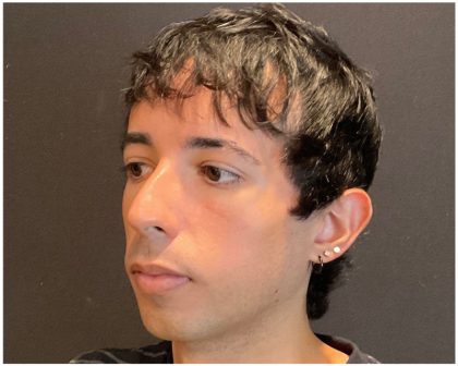 Rhinoplasty Before & After Patient #5647