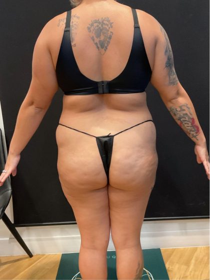 The Skinny Shot Before & After Patient #5599