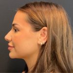 Rhinoplasty Before & After Patient #5646