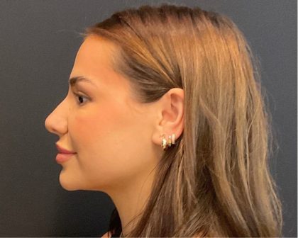 Rhinoplasty Before & After Patient #5646