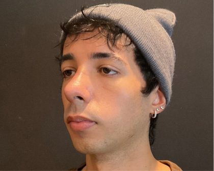 Rhinoplasty Before & After Patient #5647