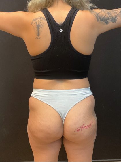 The Skinny Shot Before & After Patient #5599