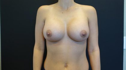 Breast Augmentation Before & After Patient #5860