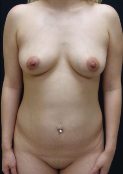 Breast Augmentation Before & After Patient #5862