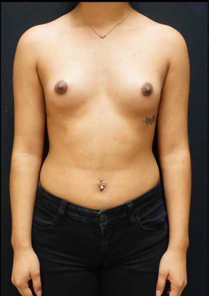 Breast Augmentation Before & After Patient #5865
