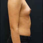Breast Augmentation Before & After Patient #5865