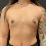 Breast Augmentation Before & After Patient #5867