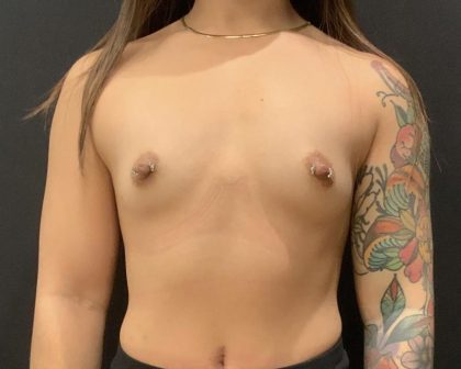 Breast Augmentation Before & After Patient #5867