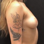 Breast Augmentation Before & After Patient #5857