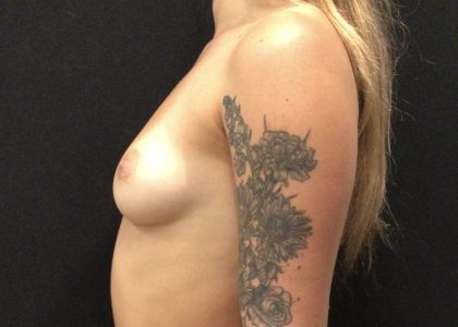 Breast Augmentation Before & After Patient #5857
