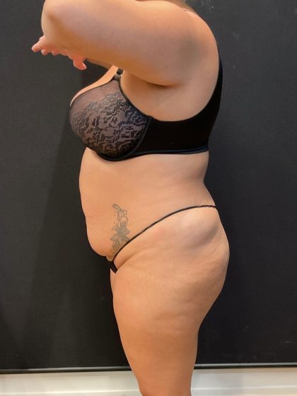 The Skinny Shot Before & After Patient #5599