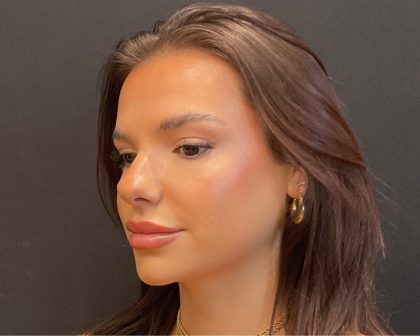 Rhinoplasty Before & After Patient #5646