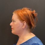 Neck Lift Before & After Patient #5107