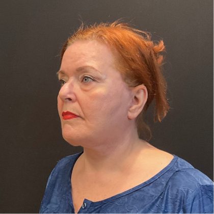 Neck Lift Before & After Patient #5107