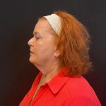 Neck Lift Before & After Patient #5107
