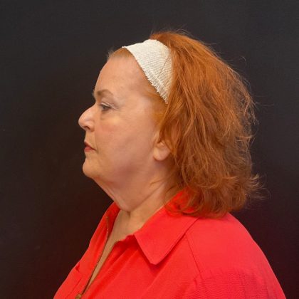 Neck Lift Before & After Patient #5107