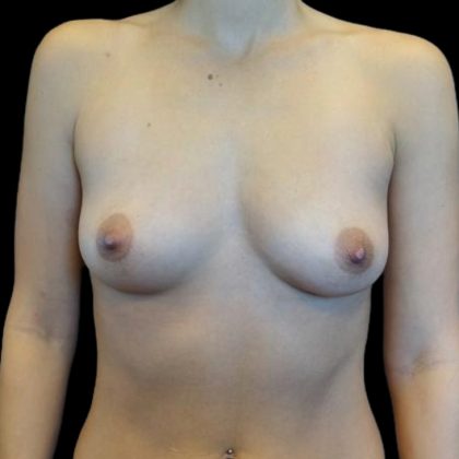Breast Augmentation Before & After Patient #5860