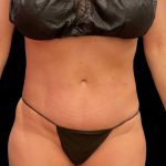 High Definition Liposuction Before & After Patient #5559