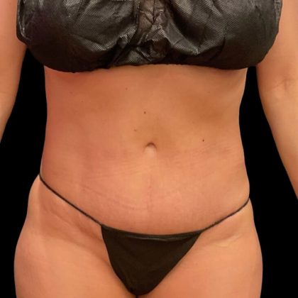 High Definition Liposuction Before & After Patient #5559