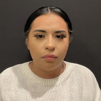 Rhinoplasty Before & After Patient #5354