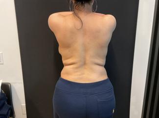 Brazilian Butt Lift Before & After Patient #5346