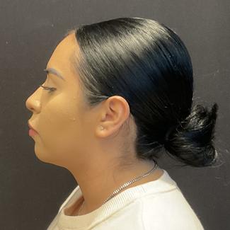 Rhinoplasty Before & After Patient #5354