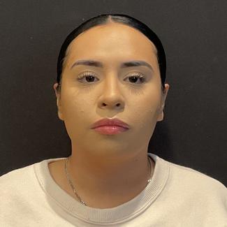 Rhinoplasty Before & After Patient #5354