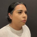 Rhinoplasty Before & After Patient #5354