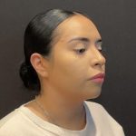 Rhinoplasty Before & After Patient #5354