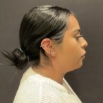 Rhinoplasty Before & After Patient #5354