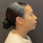 Rhinoplasty Before & After Patient #5354