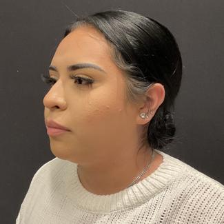 Rhinoplasty Before & After Patient #5354