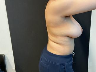 Brazilian Butt Lift Before & After Patient #5346