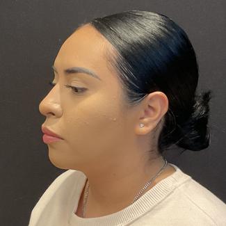 Rhinoplasty Before & After Patient #5354