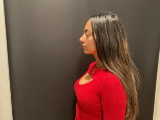 Rhinoplasty Before & After Patient #5387