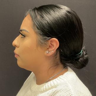 Rhinoplasty Before & After Patient #5354
