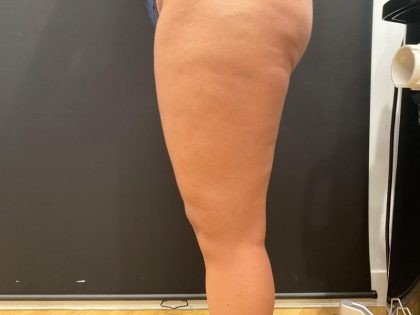 Aveli (Cellulite Removal) Before & After Patient #6435