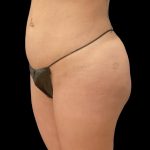 Brazilian Butt Lift Before & After Patient #6116