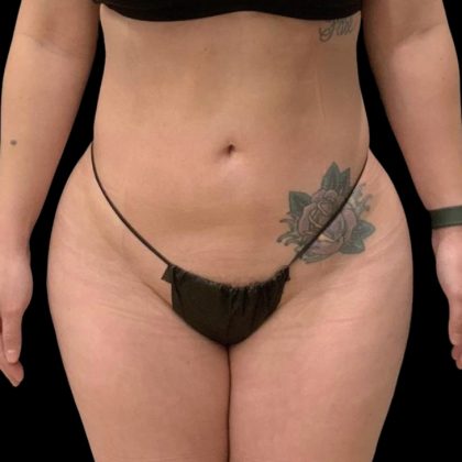 Brazilian Butt Lift Before & After Patient #6126