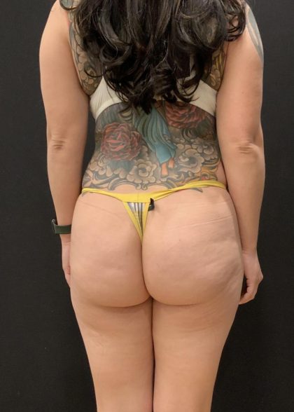 Brazilian Butt Lift Before & After Patient #6126