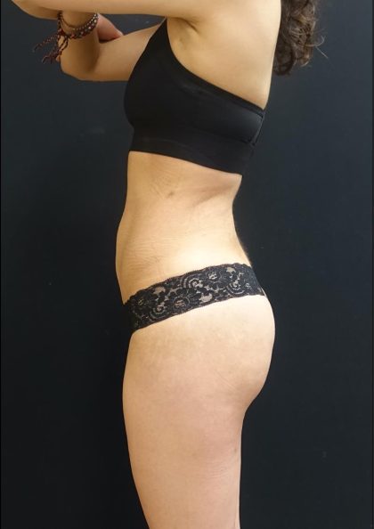 Brazilian Butt Lift Before & After Patient #6143