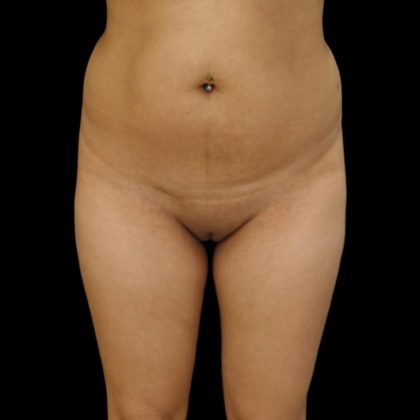 Brazilian Butt Lift Before & After Patient #6153