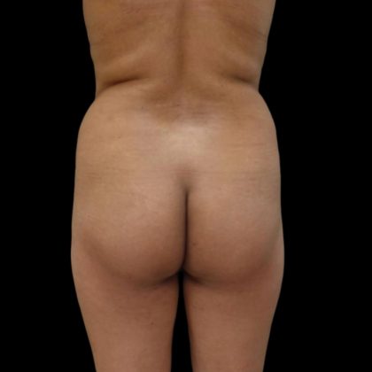 Brazilian Butt Lift Before & After Patient #6153