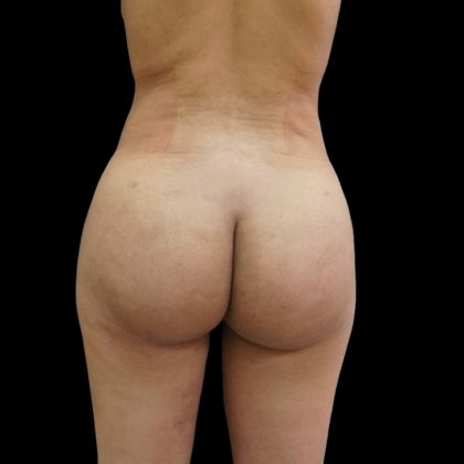 Brazilian Butt Lift Before & After Patient #6153