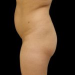 Brazilian Butt Lift Before & After Patient #6153