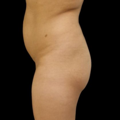 Brazilian Butt Lift Before & After Patient #6153