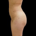 Brazilian Butt Lift Before & After Patient #6153