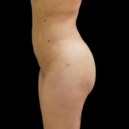 Brazilian Butt Lift Before & After Patient #6153