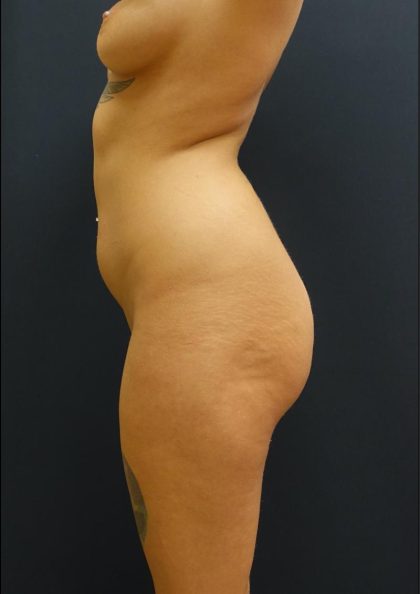 Brazilian Butt Lift Before & After Patient #6181