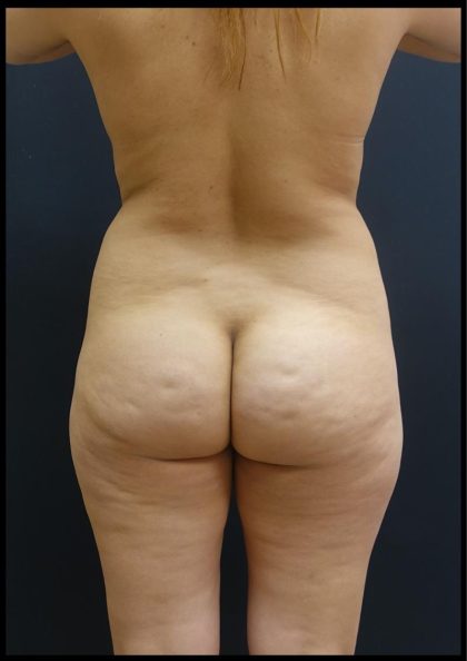 Brazilian Butt Lift Before & After Patient #6197